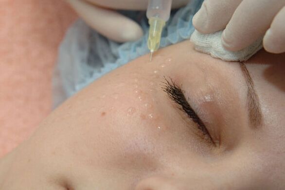 Mezoterapia - o metodă de injecție de întinerire a pielii faciale