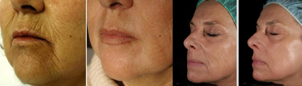 Pielea feței înainte și după procedura de întinerire cu laser