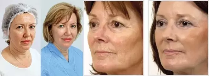 Rezultatul întineririi pielii feței cu laser este reducerea ridurilor