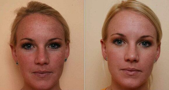 înainte și după întinerirea pielii faciale cu laser