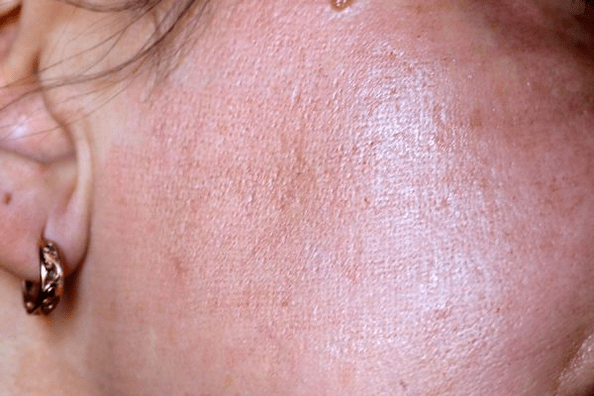 roșeață a pielii după întinerirea cu laser