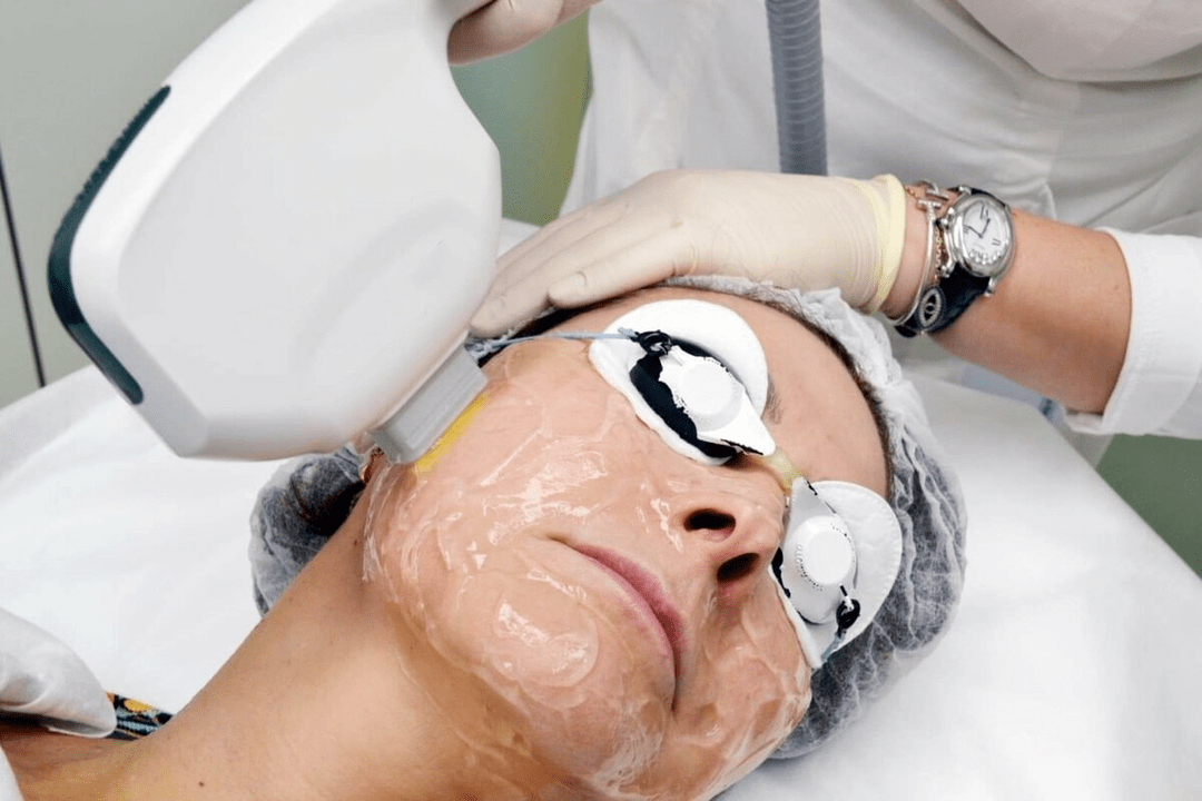 întinerire cu laser pentru pielea feței